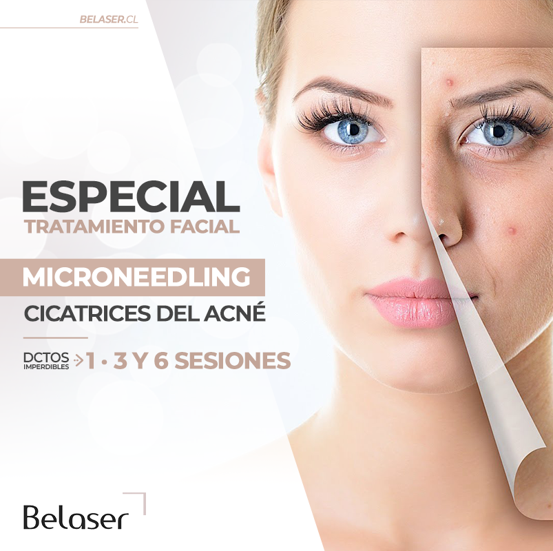 Microneedling Cicatrices Acne