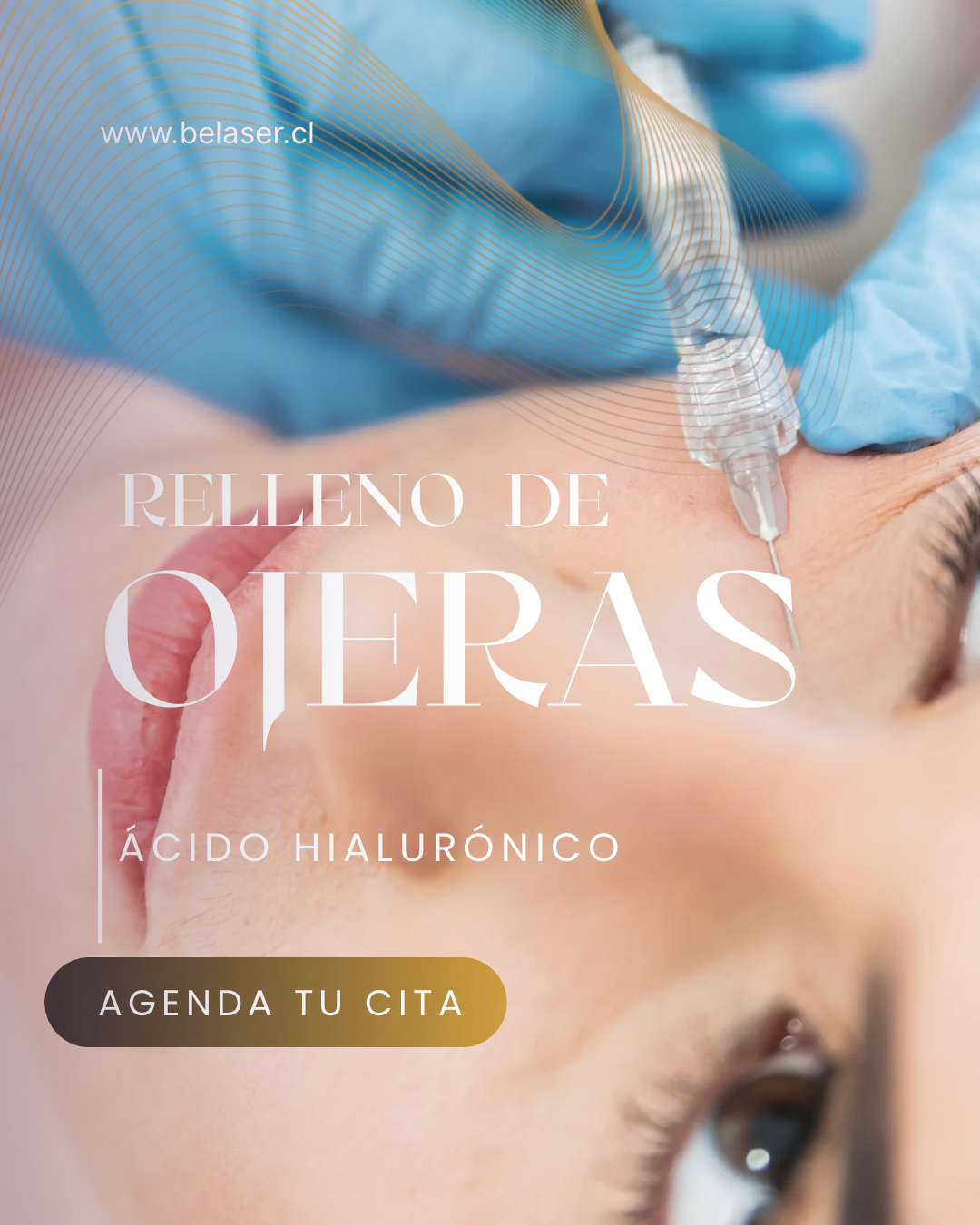 Relleno de ojeras con ácido hilurónico