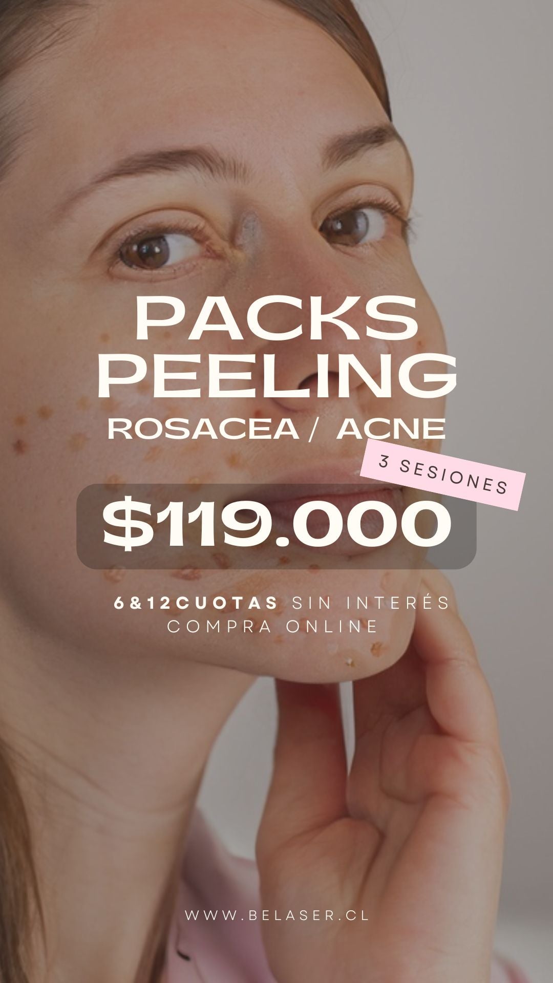 Pack peeling rosácea o acné