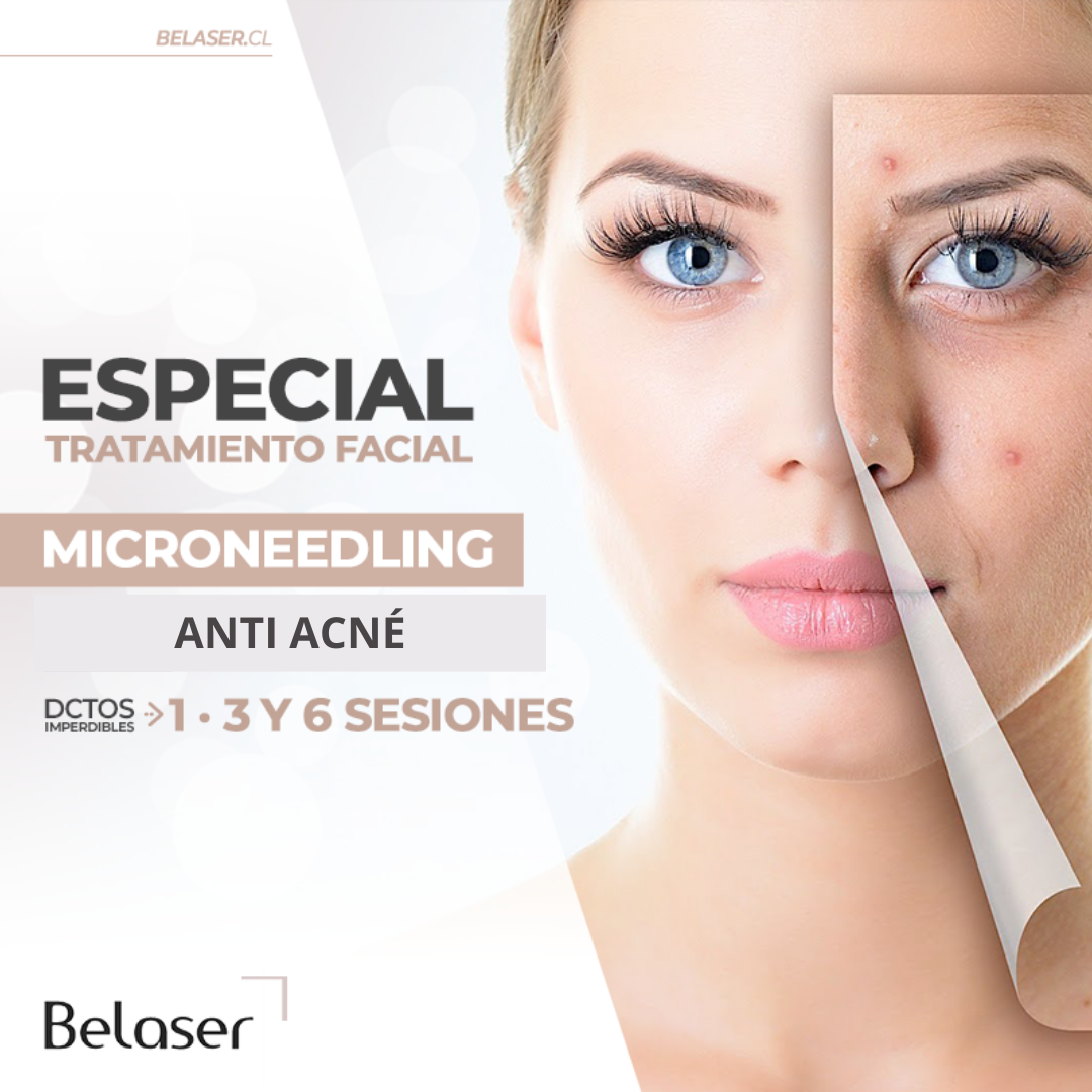 Microneedling Anti acne