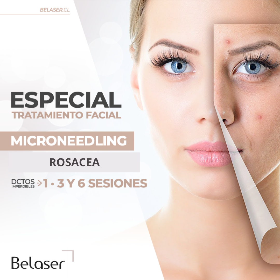 Microneedling Rosacea