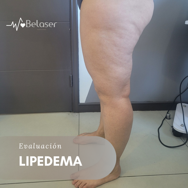 Evaluación de lipedema - Main Image