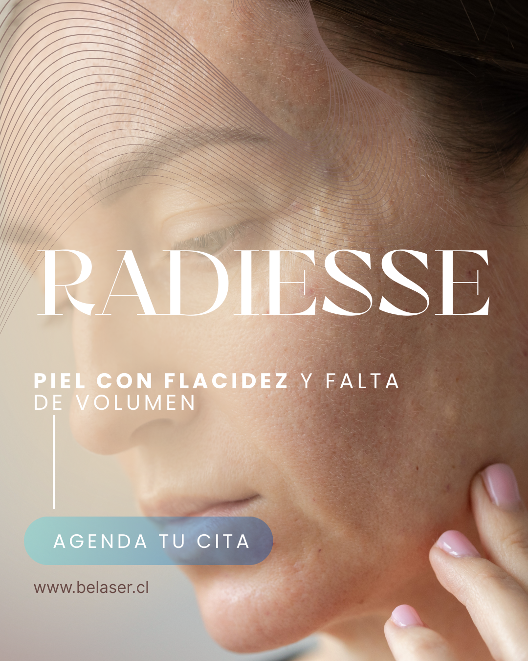 Radiesse