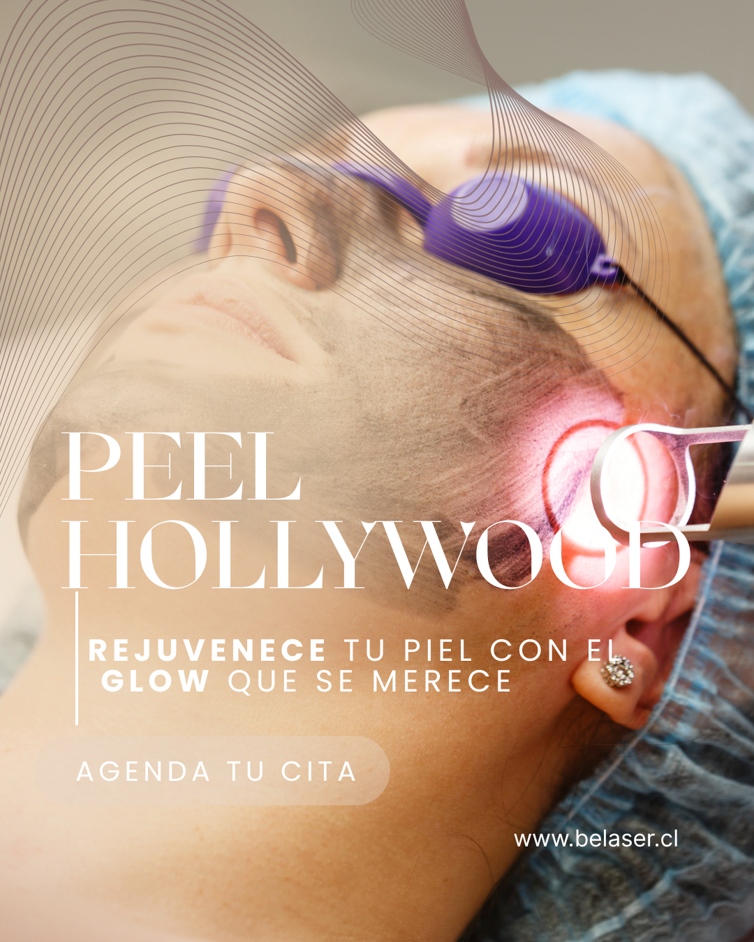 Hollywood Peel