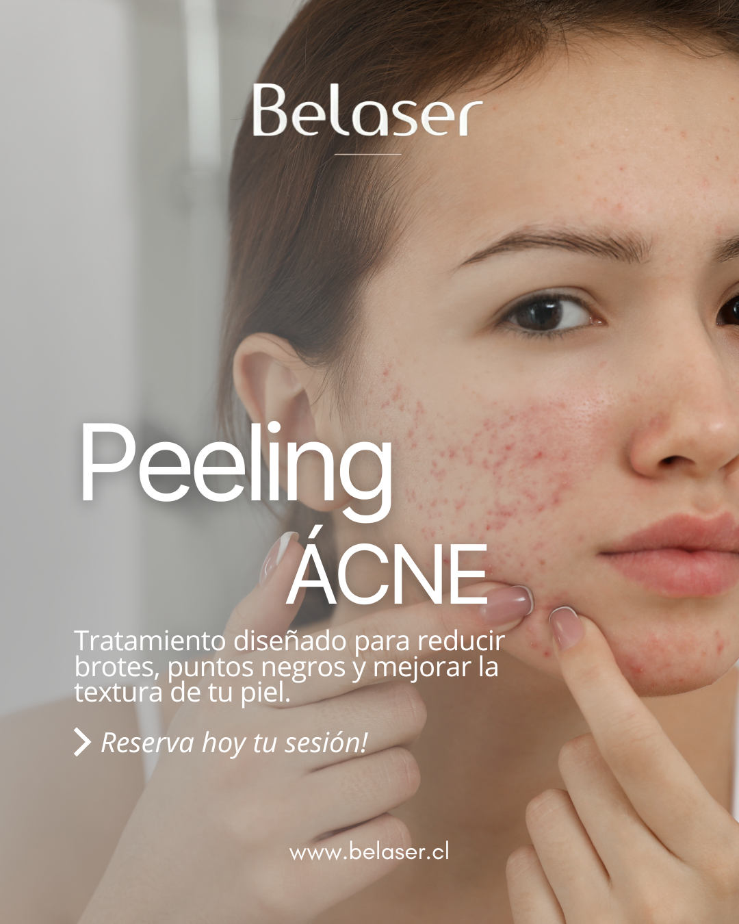Peeling Facial Acné