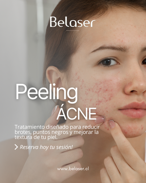 Peeling Facial Acné
