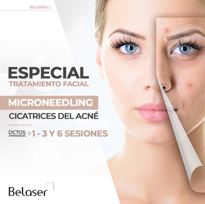 Microneedling Cicatrices Acne