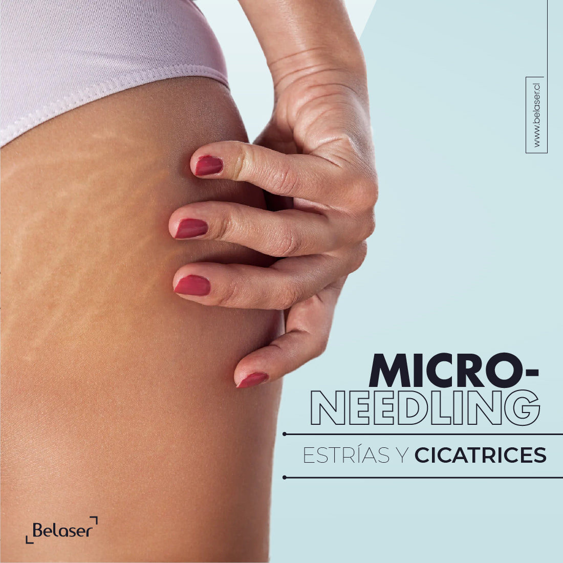 Microneedling Estrias y cicatrices