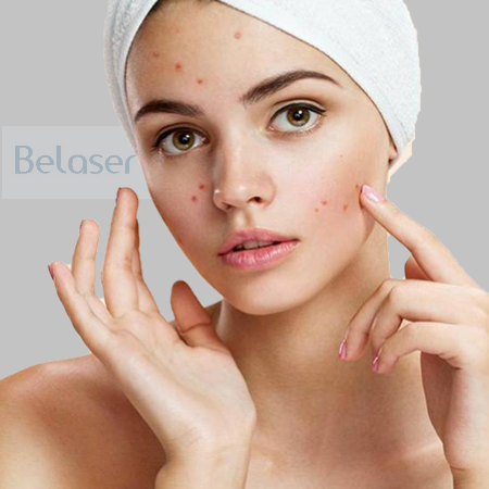 Microneedling ACNE